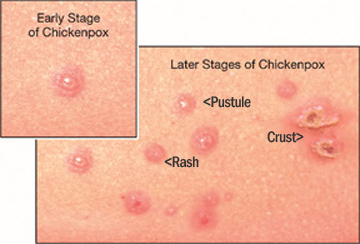 chickenpox_rash2