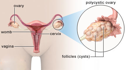 pcos1