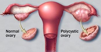 pcos2