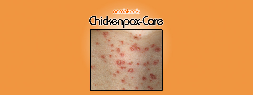 Chickenpox: Tips to prevent & treat